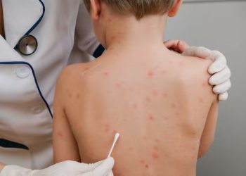 Alerta por casos de sarampión: insisten con la vacunación como herramienta clave de prevención