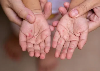 Sarampión: el dato que confirmó Nación sobre la vacunación en Mendoza