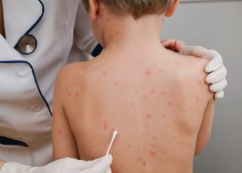 El Ministerio de Salud de la Nación emitió una alerta por sarampión: hay más de 4 brotes activos y 500 presuntos casos