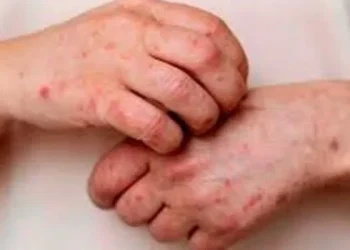 Córdoba: se confirmaron dos nuevos casos de viruela símica