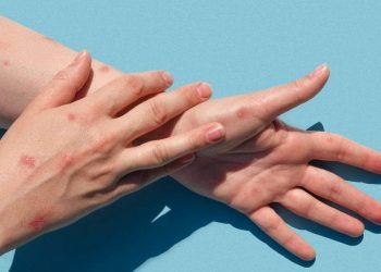 Viruela símica: ante el aumento de casos en Mendoza piden reforzar la prevención en zonas turísticas como San Rafael