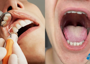 Campaña de prevención del cáncer de boca se realizará del11 al 14 de agosto en el Schestakow