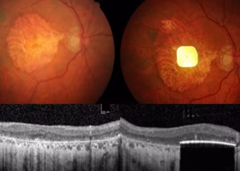 Histórico logro en la medicina: con un microchip y anteojos especiales, más de 30 pacientes recuperaron la vista
