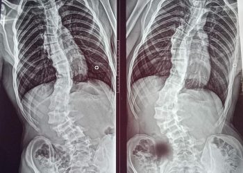 Una madre reclama por la demora en la operación de columna de su hijo y la falta de pago a prestadores de discapacidad