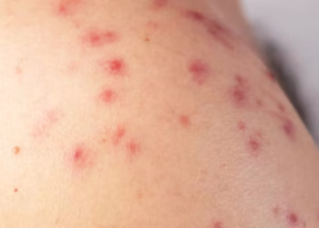 Advirtieron cómo diferenciar las manchas rojas inofensivas de las que hay que controlar