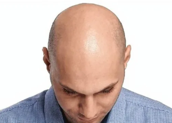 Hoy es el Día del Pelado: la historia detrás de la fecha que celebra la calvicie