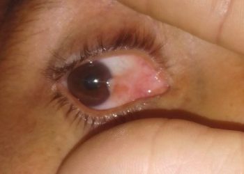 Una sanrafaelina perdió el 50% de la visión por un pterigión y busca ayuda para operarse: “No sé dónde acudir”