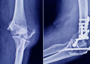 ANMAT detectó un tornillo falsificado que se utiliza en cirugías traumatológicas