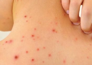 Brote de sarampión en México: registraron 9.074 casos, el mayor índice de América