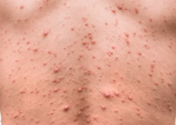 Confirmaron el primer caso de viruela del mono de la variante más contagiosa en Argentina: cuáles son sus síntomas