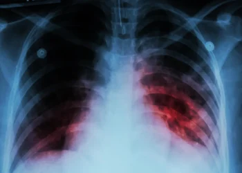 Tuberculosis: cuántos casos hay en Mendoza y quiénes son los más afectados