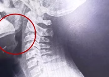 Comió una galletita y comenzó a escupir sangre: el sorprendente hallazgo que hicieron los médicos en su garganta