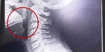 Comió una galletita y comenzó a escupir sangre: el sorprendente hallazgo que hicieron los médicos en su garganta