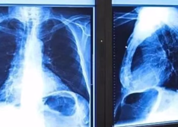 Crearon una IA capaz de tratar el cáncer de pleura que podría reemplazar a los estudios tradicionales