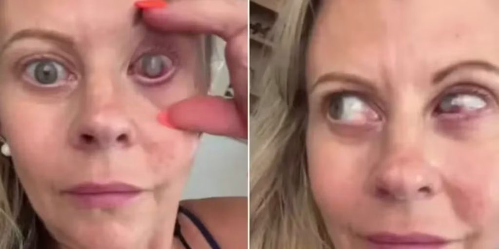 Se lavó la cara con los lentes de contacto puestos y un parásito le “devoró” el ojo: “El parto es un sueño comparado con este dolor”